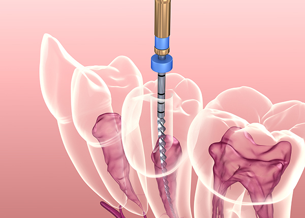 Dres Bock & Partner - Endodontie Dres Bock & Partner - Endodontie