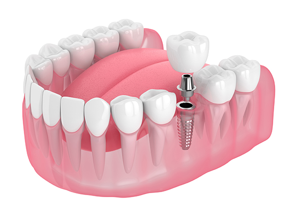 Dres Bock & Partner - Endodontie Dres Bock & Partner - Endodontie